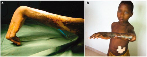 Figure 4. A case of release and full thickness graft. Preoperatory (a) and postoperatory (b) views.