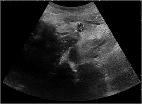 Figure 1 Left pelvic cyst-solid mass with ultrasound (size 16.3×9.7x7.6 cm). Criss-cross: left pelvic cyst-solid mass.