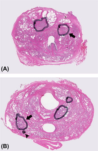 Figure 4. Example showing small tumour islets containing high Gleason grades. A) arrow pointing at a tumour with a volume < 0.22 cm3 and Gleason score 3 + 4. B) arrowhead pointing at a small tumour islet consisting of Gleason grade 5, located directly adjacent to a larger tumour with Gleason score 3 + 4. This shows that small tumour areas with high Gleason grades can be located outside the larger tumours.