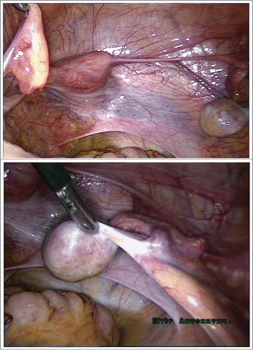 FIGURE 2. 46,XY gonadal dysgenesis with PMDS, laparoscopy. Testicle dysgenesis, Fallopian tubes, a normal shaped hypoplastic uterus and vagina. A. 46,XY gonadal dysgenesis with PMDS. Testicle dysgenesis with only Fallopian tube on the right side.