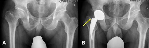 Figure 7 Coxarthrosis after Perthes’ disease (A). Metha® stem could be successfully established due to a closed cortical femoral neck ring (yellow arrow) (B).