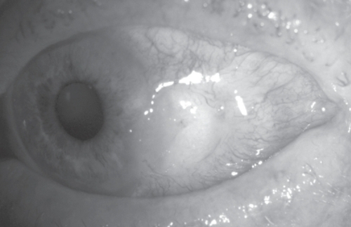 Figure 1 Spontaneous nonhealing conjunctival defect.