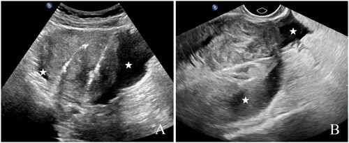Figure 3. US-guided establishment of artificial ascites and PMWA treatment for UM. A–B. Artificial ascites (white stars) form a water barrier between the uterus and surrounding tissue structures, allowing a clear display of the uterine serosa. US: ultrasound; PMWA: percutaneous microwave ablation; UM: uterine myoma.