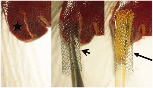 Figure 4. Demonstration of in-vivo liver bands (asterisk, left image) inserted into the metal stent (arrowhead, center image). A consequently inserted expandable tubular IRE catheter (arrow) is noted between the liver band and metal stent was (right image).