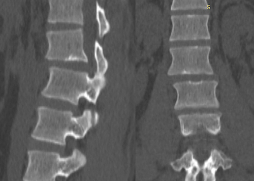 Figure 3 This 30-year-old man, victim of a motorcycle accident, neurologically intact, reported low back pain. He had a neurological deficit (AIS D) and complained of severe back pain. Sagittal and coronal CT scan images show dislocation and horizontal translation in L1-L2: Type C injury.