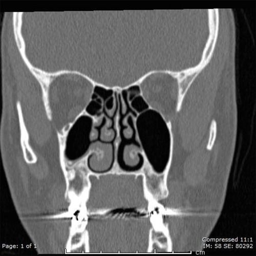 Figure 1 Paranasal CT scan showed the right accessory ostium.