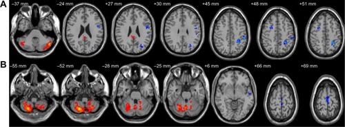 Figure 2 Altered resting-state functional connectivity (rsFC) areas of the cerebellum posterior lobe (CPL) in the sleep deprivation group.