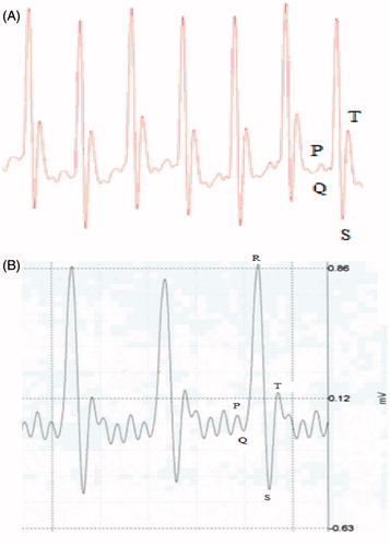 Figure 4. A representative ECG pattern for a Wistar rat. (a) Control rat. (b) Within 6 h after SC injection of BFSE (≈800 ng/rat).