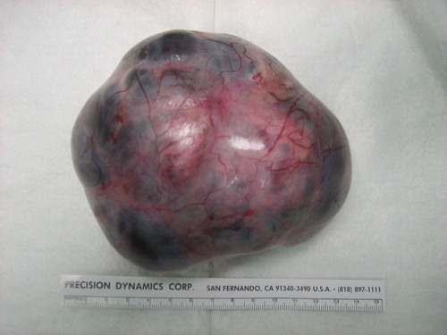 Figure 3.  Macroscopic appearance of the left ovarian teratoma from Patient 2