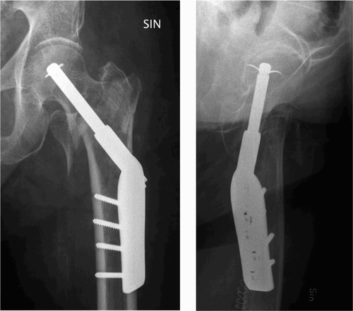 Figure 3. An intraoperative technical error with one of the hooks placed through the subchondral bone of the femoral head. The cause is usually a non-anatomical reduction of the fracture with sagging, which makes correct placement of the HTH more difficult.