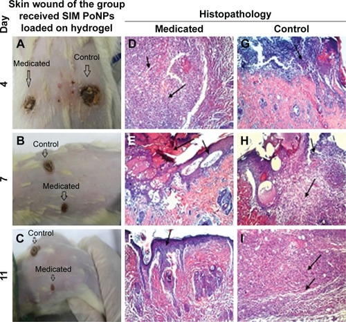 Figure 9 Skin wound and histopathology of the group received SIM PoNPs loaded with hydrogel.