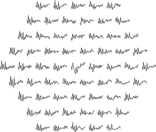 Figure 3 Multifocal electroretinographic result for a normal subject with triple-flash stimulation with three peaks in each response. The largest first peak is the response after an interval of >85 msec, the second peak after 25 msec, and the third after 35 msec.