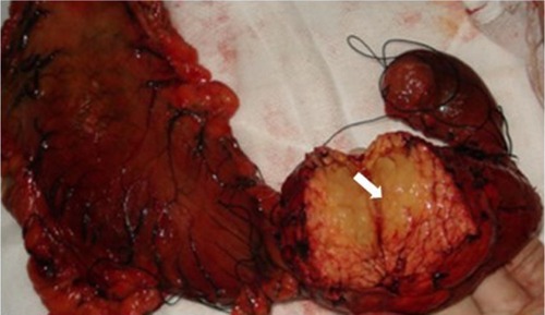 Figure 2 A gross pathological examination revealed a 3.0 × 4.0 cm multiseptated mass in the pancreatic head (arrow). The cut surface of the tumor was yellowish (arrow).