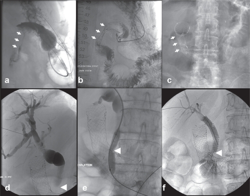Figure 3 Example of combined gastroduodenal and biliary stenting. (a) A 76-year-old female patient with inoperable duodenal adenocarcinoma encroaching the lumen of the duodenum (white arrows). (b) Transoral insertion of an 18-mm self-expanding stent (Niti-S duodenal stent, Pyramed, Esher, United Kingdom; TaeWoong Medical, Seoul, Korea) to relieve gastric outlet obstruction (white arrows). (c) Note the full expansion of the stent the following day (white arrows). (d) The next week the patient developed obstructive jaundice (likely from the stent compressing the tumor against the ampulla). (e–f) Percutaneous transhepatic cholangiography demonstrates marked dilatation of the biliary tree, which was treated with biliary stent insertion (Zilver, Cook Medical, Bloomington, United States) after ballooning through the duodenal stent mesh. Note the stent placed in the common bile duct and extending across the mesh of the duodenal stent (white arrowhead).