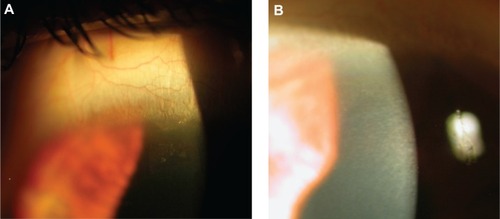 Figure 1 Slit-lamp photograph on the first postoperative day (A) showing white granular reaction with the presence of blood droplets, resembling diffuse lamellar keratitis into the flap tunnel. On the fifth postoperative day, diffuse lamellar keratitis was completely resolved after corticosteroid treatment (B).