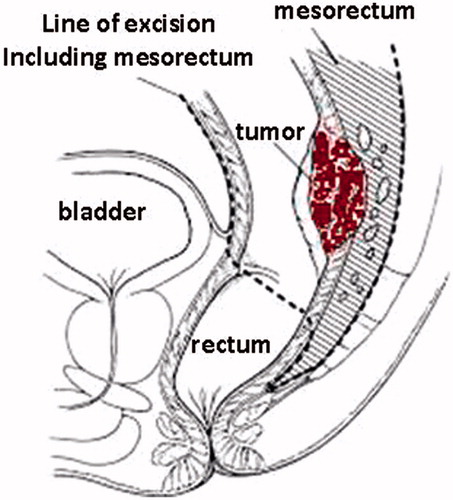 Figure 4. Sketch showing the principles and extent of Total Mesorectal Excision – TME