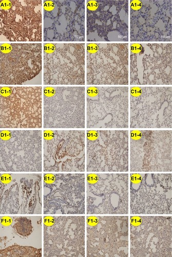 Figure 15 Representative SATB1, Wnt1, β-catenin, E-cadherin, vimentin, and SNAIL expression in lung metastases of nude mouse model by immunohistochemistry.