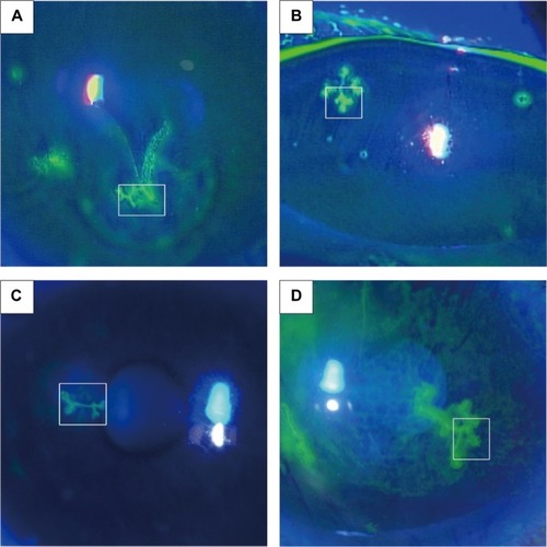 Figure 1 Fluorescein slit-lamp photographs of dendritic ulcers with terminal bulbs in Case 1 (A), Case 2 (B), Case 3 (C), and Case 4 (D).