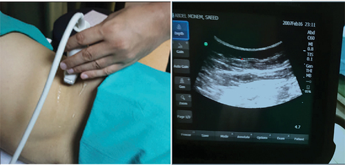 Figure 2. Ultrasound-guided QLB.