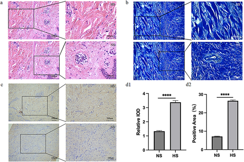 Figure 3 Pathological Histogram (a and b): HS patients have a large amount of thickened and irregularly arranged collagen fibers, which are thick and some can form collagen nodules. In NS patients, the subcutaneous collagen fibers are arranged regularly, and the skin tissue structure is present and normal. (c and dii) Immunohistochemistry showed a strong TNC immune response in HS tissue, which was significantly different from the NS group (****p<0.001).