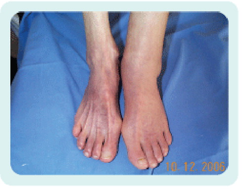 Figure 1. Acrocyanosis in severe anorexia nervosa.Note dyscrasic edema in left leg.