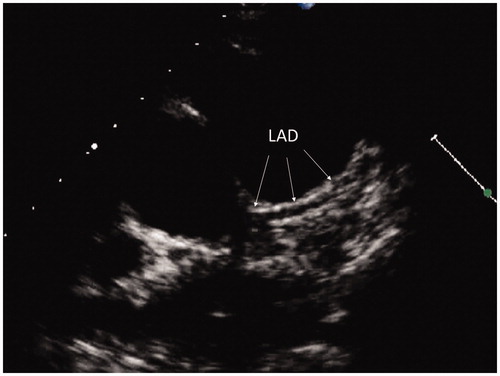 Figure 3. Standard parasternal short axis view. LAD: left anterior descending coronary artery.