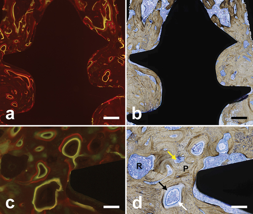 Figure 3. (a) Fluorescence photomicrograph of a section of a sheep femur containing a titanium screw implanted intra-cortically 12 weeks earlier. Intravital fluorochrome labelling was performed using calcein (yellow to green labels) and alizarin (red labels) administered 2 weeks apart. Darker areas (other than the metal) correspond mostly to either soft tissues or osseous tissues that existed before the administration of the fluorochromes. Scale bar = 500 µm. (b) The same section after staining using the von Kossa and toluidine blue method. Scale bar = 500 µm. (c) Fluorescence photomicrograph of the interfacial region at a higher magnification. Scale bar = 150 µm. (d) The same area after von Kossa and toluidine blue staining. Osteoid (black arrow) can be readily identified interspersed between the darkly stained mineralized matrix and the highly basophilic osteoblasts (white arrow). Here, the cross section of a resorption cavity at the level of its cutting cone can also be seen exhibiting active osteoclasts (yellow arrow) resorbing pre-existing bone (P). R denotes a cross section of another resorption cavity at a level where osteoblastic activity has just started (at its right margin) and the first layer of osteonal lamellae is being laid down. Scale bar = 150 µm.