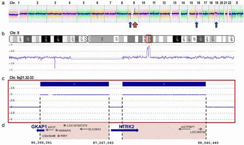 Figure 2. Microarray results. (a) Whole genome microarray profile (weighted log2) from CytoScanHD analysis in ChAS showing gains (red arrow) in chr. 9q and three smaller losses (blue arrow) in chr. 9, 16 and 19 (for details see Supplementary Table S1). (b) Smooth signal image of chr. 9 showing the two peaks of the gains. (c) Copy number state of chromosome region 9q21.32–33 leading to breakpoints within the GKAP1 and NTRK2 genes. (d) Schematic representation of genes located within the two gained regions, and estimated breakpoint positions in GRCh37/Hg19 according to the calling in ChAS