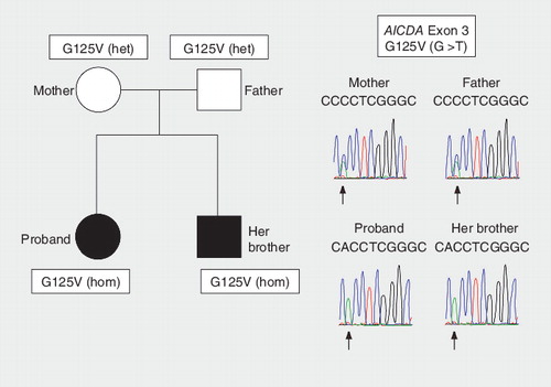 Figure 1. Novel mutation at the exon 3 of the AICDA gene.The patient codon 125 has changed from GGG to GTG in the patients and their parents. Mutation analysis showed homozygous mutation in patients and heterozygous mutation in the parents.