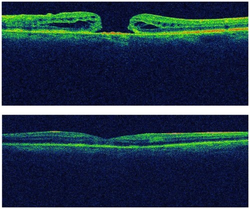 Figure 3 OCT of stage 4 macular hole of the right eye in a 70-year-old patient. Preoperatively (top) and postoperatively, after removal of silicone oil (bottom).