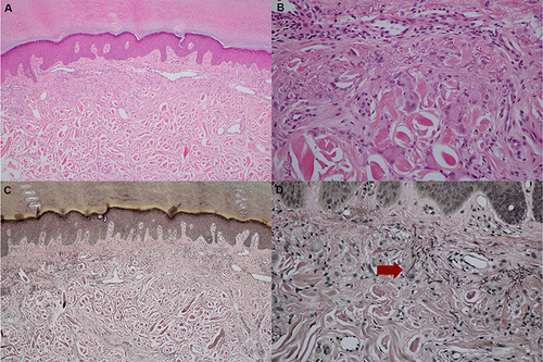 Figure 4 Histopathology: (A) Granulomatous inflammation and thickened degenerative collagen (Hematoxylin and Eosin, x100). (B) Presence of elastophagocytosis (Hematoxylin and Eosin, x400). (C and D) Increase in fragmented elastic fibers with elastophagocytosis (red arrow) in the upper dermis but decrease in elastic fibers within the granulomatous area (Verhoeff-Van Gieson, x100 and x400 original magnification).