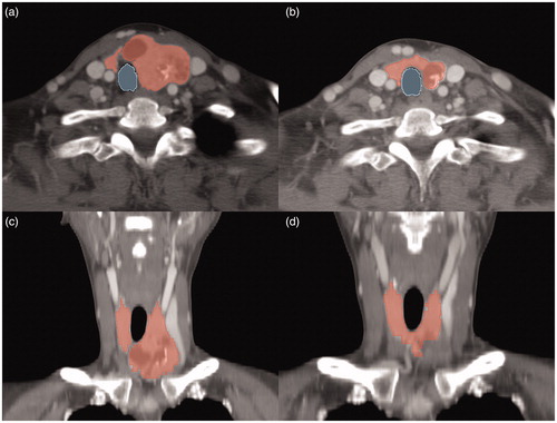 Figure 2. Contrast-enhanced axial (a, b) and coronal (c, d) CT images for a representative case involving a 32-year-old woman with benign nodular hyperplasia in the left thyroid gland. Volumetric segmentations of the thyroid glands are shown in red while cross-sectional segmentation of the trachea is shown in blue.