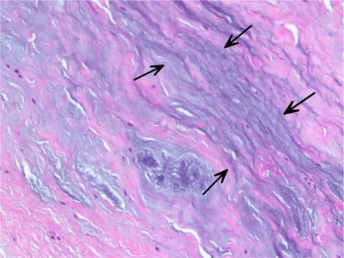 Figure 2 Myxoid ground substance, visible as blue–gray amorphous material (arrows), separating collagen bundles within a hematoxylin and eosin-stained section.