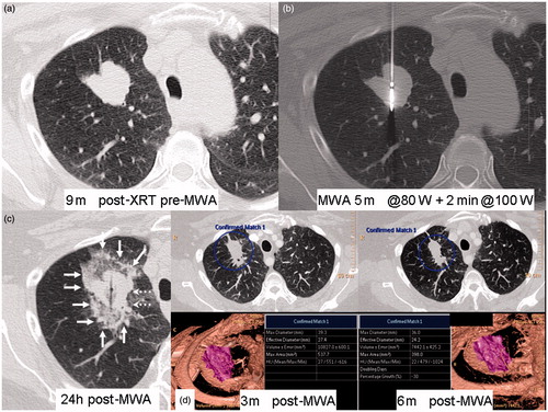 Figure 2. A 55-year-old patient with recurrence of right upper lobe (RUL) non-small cell lung cancer (NSCLC) after 60 Gy of radical external beam radiation. (a) Axial CT lung window shows lobulated RUL mass. (b) Central position of microwave antenna within the tumour. (c) Axial CT scan 24 h after MWA shows surrounding ground-glass opacity (GGO) around tumour (arrows); medial lack of GGO at level of dashed arrows. (d) Volumetric comparison between 3 months post-ablation scan and 6 months post-ablation scan showing reduction in size by 30%, qualifying as partial response under RECIST criteria.