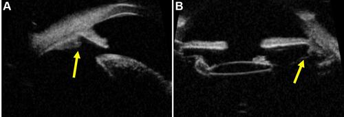 Figure 4 Ultrasound biomicroscopic (UBM) images demonstrating zonular tear ((A and B) Yellow arrow) in the presence of crystalline lens (A) in a 36-year-old patient with blunt trauma and posterior chamber intraocular lens (B) in a 22-year-old patient with blunt trauma respectively.