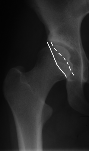 Figure 2B. Part of an anteroposterior pelvic radiograph showing anteversion of the right acetabulum. The anterior (dashed line) and posterior (solid line) acetabular rims are shown.