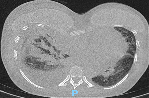 Figure 3 Chest CT scan with “tree-in-bud” lesions on the upper right lobe.