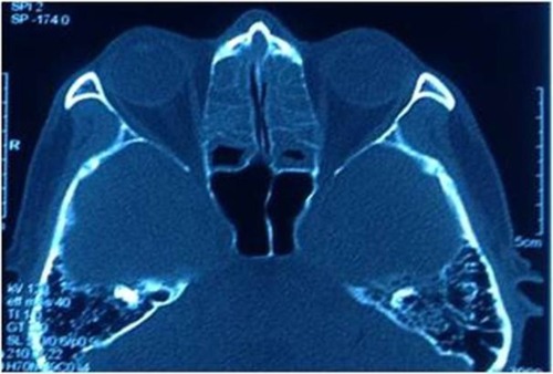 Figure 4 Contrast-enhanced CT of paranasal sinuses done prior to functional endoscopic sinus surgery, showed no orbital cystic lesion at the left orbital apex.