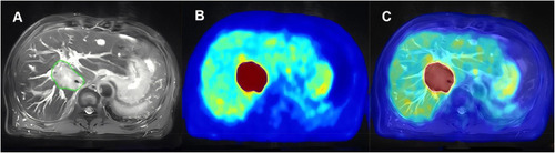 Figure 1 73-year-old male with colorectal liver metastases. (A) The green line represents GTV-MRI; (B) The blue line represents GTV-PET; (C) The white line represents GTV-PET/MRI.