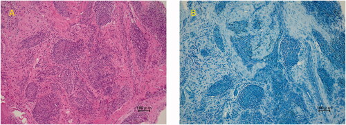 Figure 4. The pathological finding of the synovial sheath with HE staining showed epithelioid cell granuloma (A). However, there were no mycobacteria with Thiel-Nielsen staining (B).