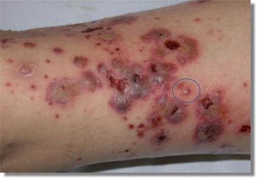 Figure 2 Leg vasculitis: The blue ring indicates the selected lesion for the biopsy because of an early and untreated lesion.