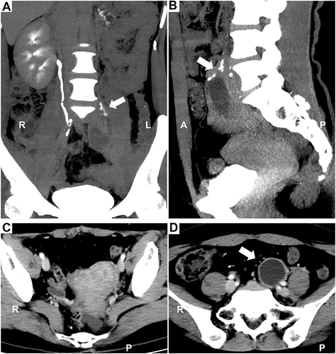 Figure 1 Images of computerized tomography urography (CTU). There were no abnormalities in the shape and position of the right kidney, and no dilation of the right ureter. No normal kidney was found in the left renal area (A). An ectopically dysplasia kidney with peripheral enhancement could be seen anterior to fifth lumbar vertebra (B). Spotted contrast media was demonstrated around the ectopic kidney (thick arrow, (B). However, an enlarged uterus can be seen (C) and the thick-walled dysplasia kidney resembles an ovarian cyst (thick arrow, (D).