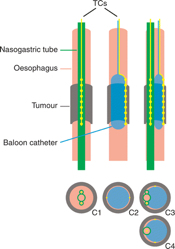 Figure 1. Schematic representation of the three types of intra-luminal thermometry used for temperature and SAR measurements at oesophageal tumour locations. Left: multi-sensor thermocouple probes (TCs) inserted in two opposing lumina of a three-lumen nasogastric tube (configuration C1). Middle: TCs mounted on an inflatable balloon catheter (configuration C2; for clarity only one TC is drawn in the upper picture). Right: TCs inside a three-lumen nasogastric tube or a regular single lumen nasogastric tube and TCs mounted on a balloon catheter used simultaneously (configurations C3 and C4).