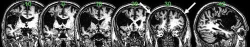 Figure 1. MRI images showing coordinates and location of tDCS stimulation sites (arrows).