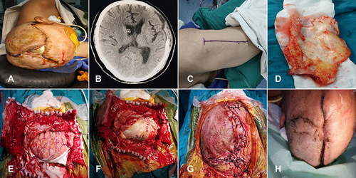 Figure 1 Case 1 (A) Preoperative photograph showing a large scalp defect, with a piece of bovine pericardium graft and cortex exposed. (B) Preoperative CT image showing cerebrum mildly bulge outward the bone window. (C) Photograph showing a linear incision on the anterolateral thigh to harvest free fascia lata. (D) A large piece of free fascia lata was harvested, preparing for dura repair. (E) Intraoperative photograph showing a lot of pus on the surface of cortex when the alien dura was removed. (F) Intraoperative photograph showing dural defect was completely repaired in tension-reduced fashion. (G) The incision was closed after extensive subgaleal dissection. (H) The incision healed uneventfully 1 month after the debridement surgery..