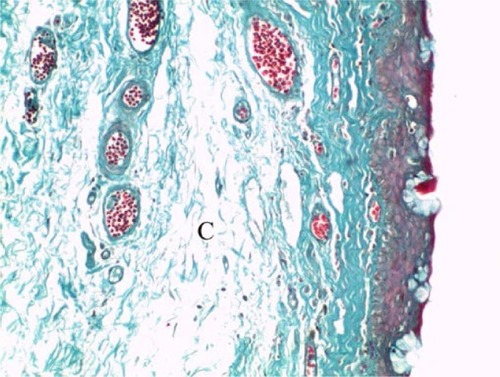 Figure 5 A photomicrograph of untreated pterygium section showing subepithelial connective tissue that is rich in collagen fibers.