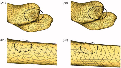 Figure 6. Partial graphs of femur mesh. (A1) Mesh generation result of proposed method, (A2) Mesh generation result of proposed method, (B1) Mesh generation result of hypermesh software and (B2) Mesh generation result of hypermesh software.