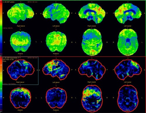 Figure 4 Brain three-dimensional stereotactic surface projection maps of positron emission tomography scans with activity maps in the top two rows and z maps showing deviation from a normal control cohort in the third and fourth rows.