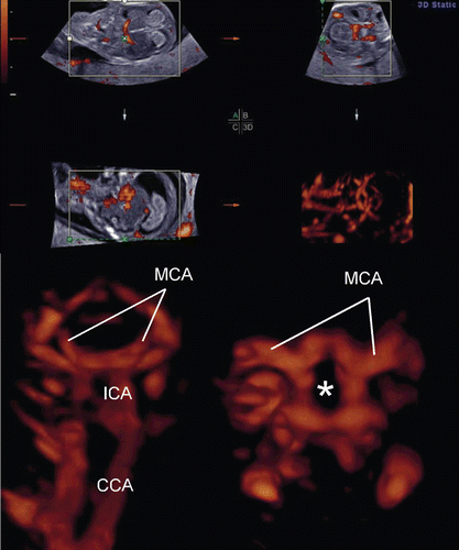 Figure 8.  Premature vascularity of normal 12 week brain. (upper) Three orthogonal view of power Doppler image and 3D reconstructed image (front-back view of A plane). (lower left) Front-back image of common carotid arteries (CCA), internal carotid arteries (ICA) and brain basilar arteries. MCA; middle cerebral artery. (lower right) 3D.