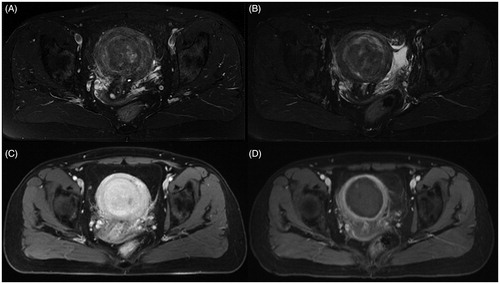 Figure 1. Transverse view of MR images obtained before and 1 day after HIFU treatment. (A). A pre-HIFU T2 weighted image showed multiple nodules with the largest one at a 6 cm protruding into the uterine cavity; (B). A post-HIFU T2 weighted image showed the signal intensity of the largest fibroid decreased; (C). A pre-HIFU contrast MR image showed hyperenhancement of the fibroids; (D). A post-HIFU contrast MR image showed no perfusion in the largest fibroid. The largest fibroid was completely ablated.